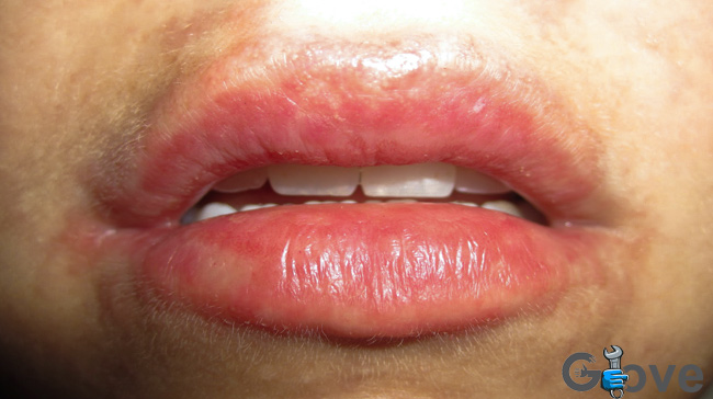 What-does-latex-allergy-look-like-on-lips.jpg